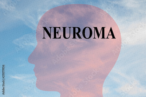 NEUROMA - medical concept photo