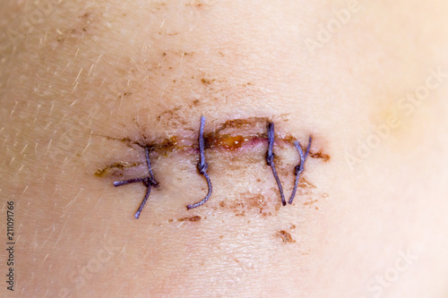 Cut wound with four sutures superimposed