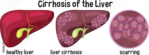 Cirrhosis of the liver