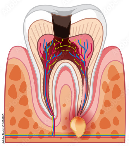 A Human Tooth Decay and Cavity