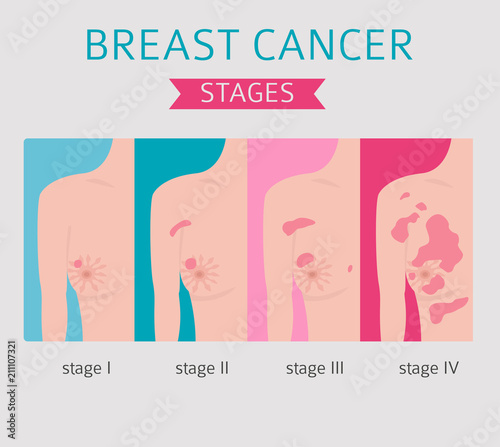 Breast cancer, medical infographic. Diagnostics, symptoms, treatment. Women`s health set