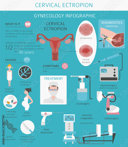 Cervical ectropion. Ginecological medical desease infographic