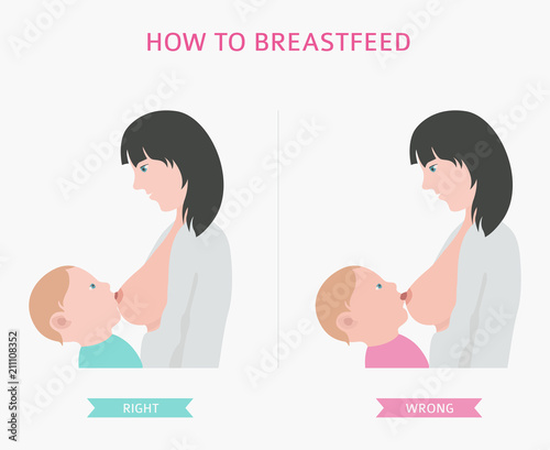 Mastitis, breastfeed, medical infographic. Diagnostics, symptoms, treatment. Women`s health icon set