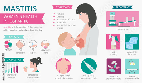 Mastitis, breastfeed, medical infographic. Diagnostics, symptoms, treatment. Women`s health icon set