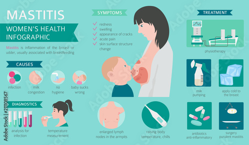 Mastitis, breastfeed, medical infographic. Diagnostics, symptoms, treatment. Women`s health icon set