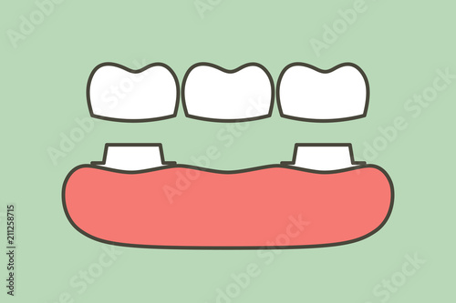 dental crown with bridge, installation process and change of teeth