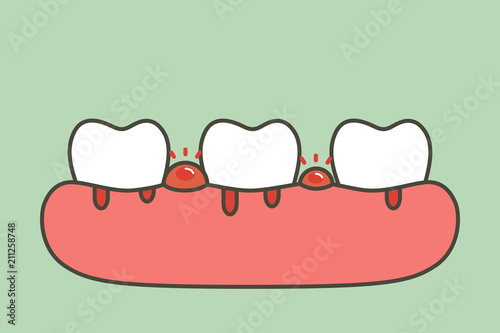periodontitis or gum disease with bleeding - teeth cartoon vector flat style