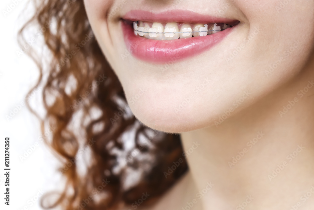 Young european woman smiling in ceramic braces. Happy smile. Girl with curly red hair Isolated on white background Young european woman smiling in ceramic braces. Happy smile. Girl with curly red hair Isolated on white background