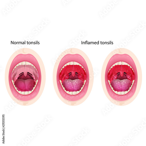 Normal and inflamed tonsils