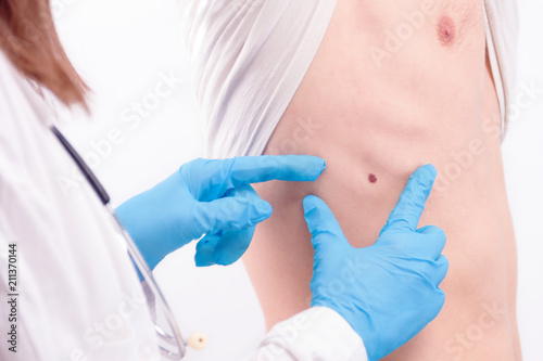 Oncological disease concept. Doctor wearing white coat and stethoscope in gloves examining melanoma on man’s skin. photo