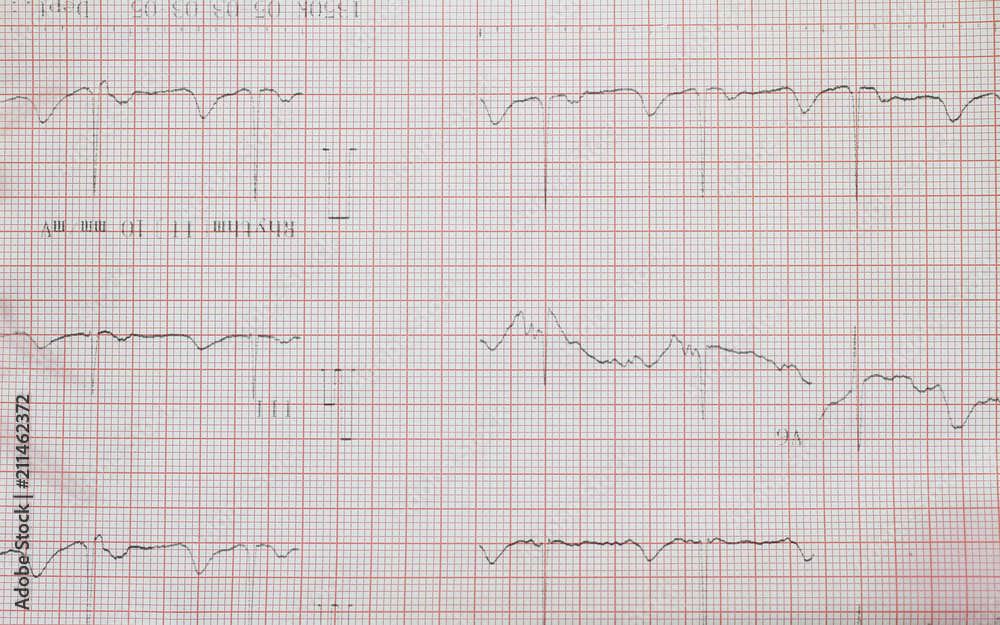 Electrocardiogram of wave in paper report analysis. Medical and healthcare concept. Electrocardiogram of wave in paper report analysis. Medical and healthcare concept.