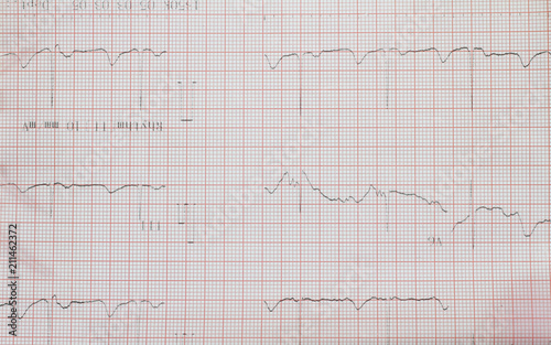 Electrocardiogram of wave in paper report analysis. Medical and healthcare concept.