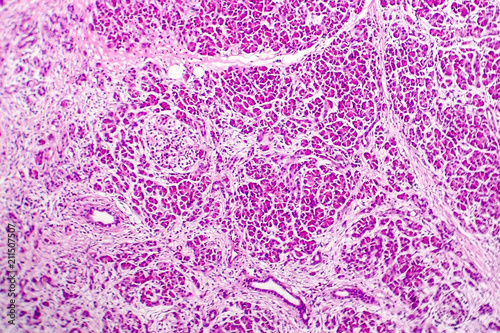 Φωτογραφία Acute hemorrhagic pancreatitis, light micrograph, hematoxylin and eosin staining