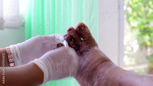 cleaning infected wound on foot  photo