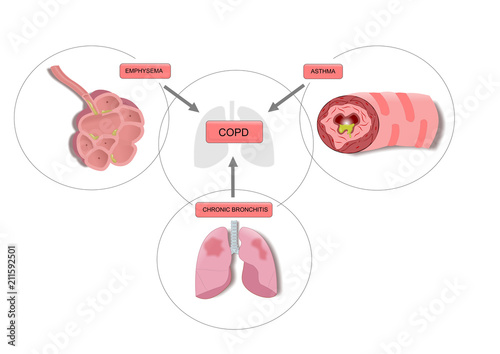 Copd Disease Acronym For Chronic Obstructive Pulmonary Disease A Combination Of Emphysema Asthma And Chronic Bronchitis Stock イラスト Adobe Stock