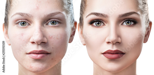 Woman with acne before and after treatment and make-up. photo