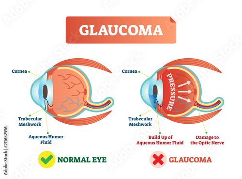 Vector illustration of glaucoma illness. Cross section comparement with normal and damaged eye. Scheme with cornea, trabecular meshwork and aqueous humor fluid. photo
