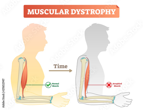 Vector illustration about muscular dystrophy. Compared normal muscle and atrophied muscle. Medical scheme how time affects health - healthy and weak human. photo