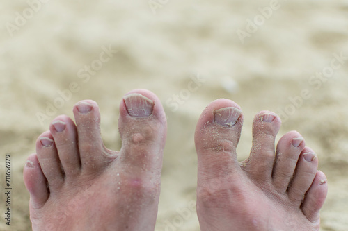  Unwell groomed toenails. Fungus on the nails. © Konstiantyn Zapylaie