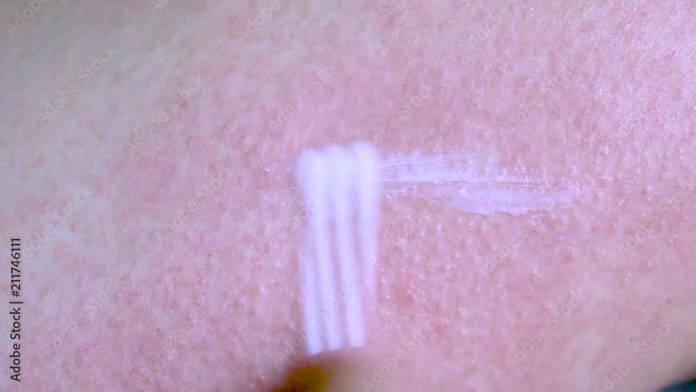 Allergic rash dermatitis eczema on skin. Allergic rash dermatitis eczema on skin.