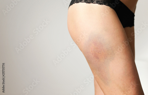 Closeup Bruise on wounded woman's leg.Young woman with a hematoma on hip. photo