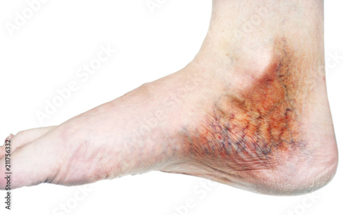 human leg with blocked veins, thrombosis, phlebitis, and standing on a white background, with depth of field Photo