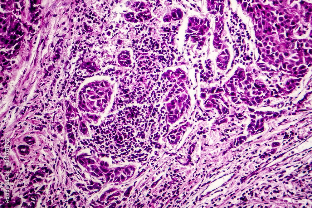 Lymph node metastasis, light micrograph of cancer that has spread to a ...