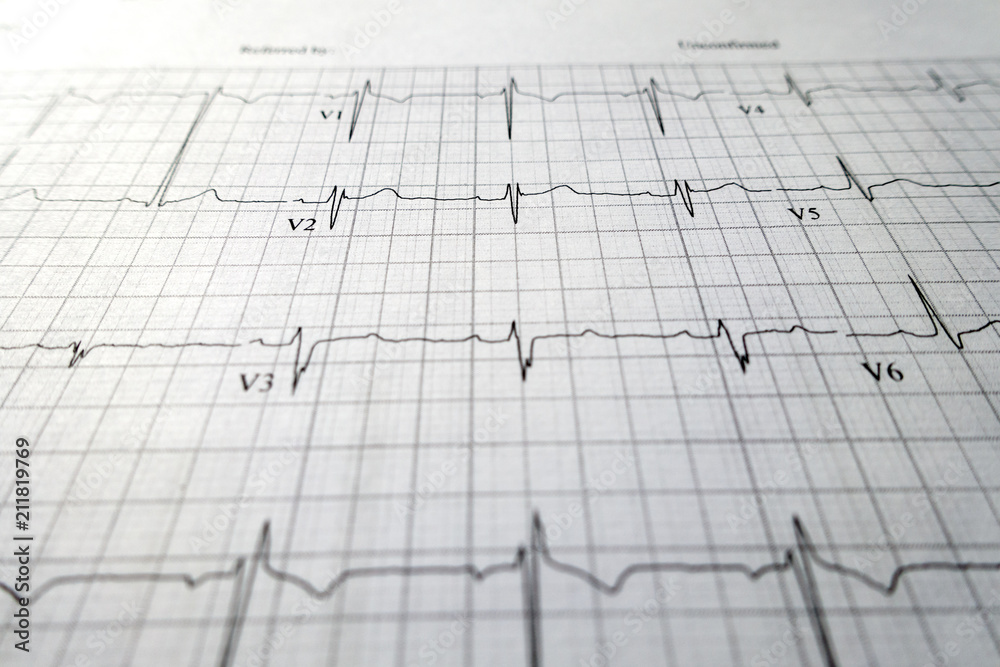 heart test ekg sheet print outc close up heart test ekg sheet print outc close up