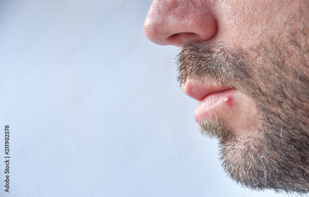 Young bird man with big yellow pimple on the lower lip Young bird man with big yellow pimple on the lower lip