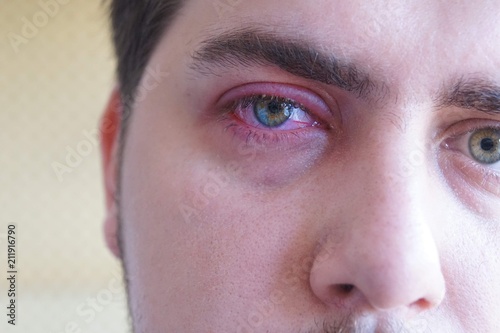 Obraz na plátne Close up right upper eyelid abscess