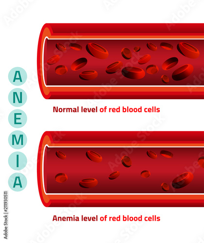 Anemia level of blood cells