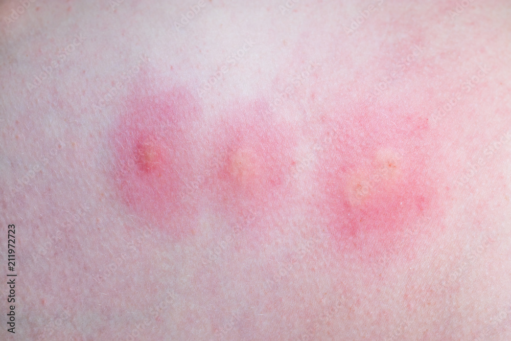 Mosquito bite to the foot. Inflammation. Mosquito bite to the foot. Inflammation.