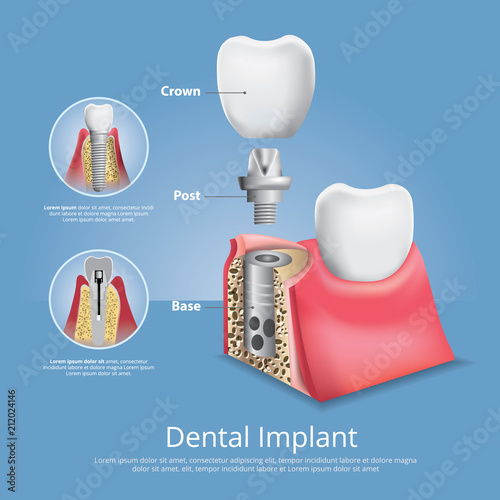 Human teeth and Dental implant Vector Illustration