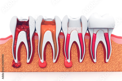 stages of root canal treatment photo