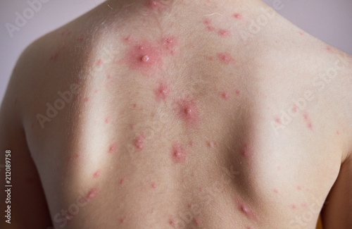 Little girl with a chickenpox on her back