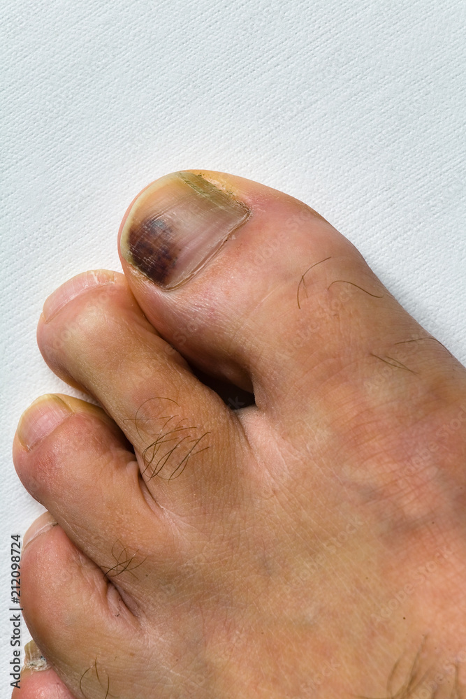 The bruised finger of the male foot close-up.