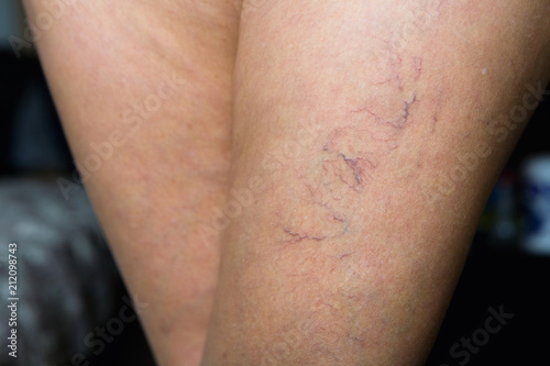 Ugly small veins are visible on the female leg.