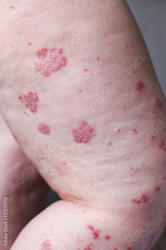 Psoriasis vulgaris is an autoimmune disease that affects the skin, detail photography for mainly medical magazines. Atopic dermatitis or eczema, is a type of inflammation of the skin at foot.