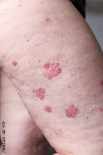 Psoriasis vulgaris is an autoimmune disease that affects the skin, detail photography for mainly medical magazines. Atopic dermatitis or eczema, is a type of inflammation of the skin at foot. photo