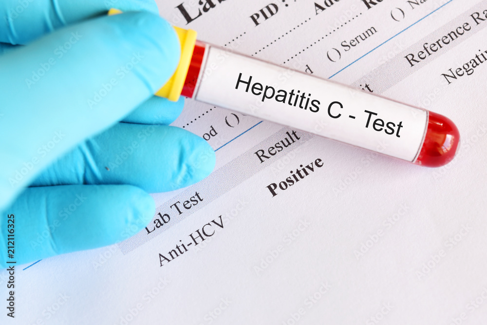 Hepatitis C virus positive test result with blood sample tube - obrazy, fototapety, plakaty 