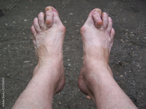 Bare foots which have Hallux Valgus (bunion) problem.