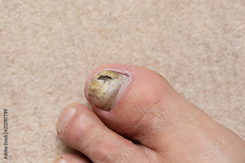 Close-up of ill male foot thumb nail, fungal nail.