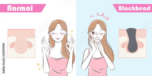 woman with blackhead problem