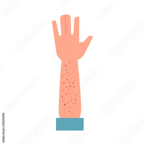 Human hand affected small red rash - symptom of allergy or eczema isolated on white background. Dermatologic disease of skin on arm - atopic dermatitis health in flat vector illustration.