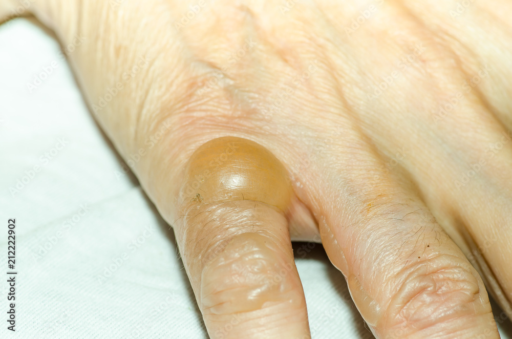 Blisters or bleb on the finger skin after burn it with hot oil while