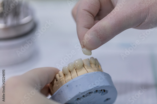 Gypsum Stomatologic human jaws. Ceramic-metal crown on plaster model photo