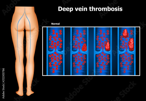 vein-thrombosis