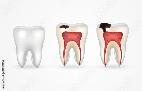 Tooth caries and healthy tooth. Superficial caries; deep caries; enamel and dentin decay; periodontitis. 3d realistic tooth inside and out.