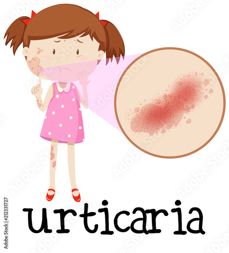 Young girl with urticaria