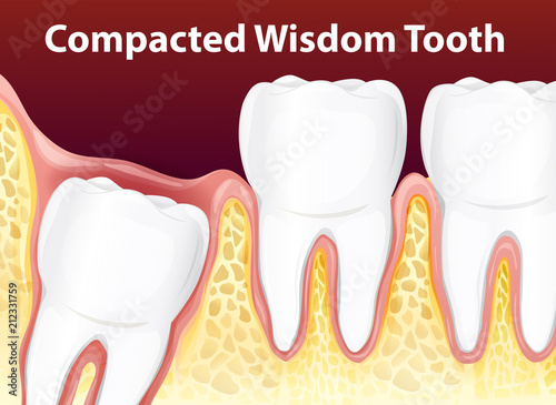 Compacted Wisdom Diagram Tooth